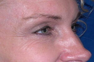 https://amaramd.com/wp-content/uploads/2020/02/botox_02-before-1-300x200.jpg