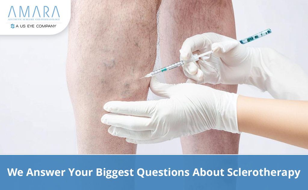 We Answer Your Biggest Questions About Sclerotherapy