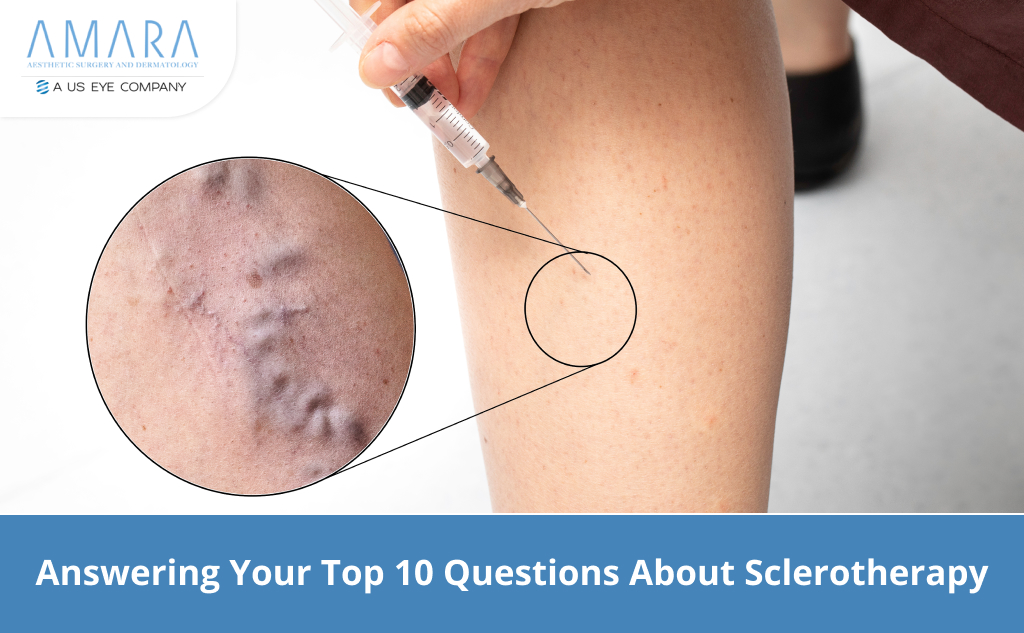 Answering Your Top 10 Questions About Sclerotherapy