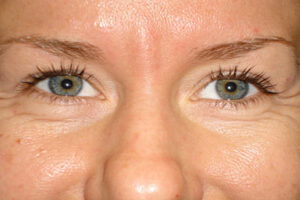 https://amaramd.com/wp-content/uploads/2025/04/botox_01-before-300x200.jpg