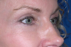 https://amaramd.com/wp-content/uploads/2025/04/botox_02-after-1-1-300x200.jpg