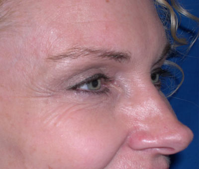 botox_02-new-before-1