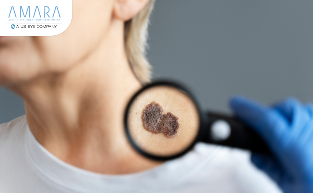 Close-up of skin cancer screening with magnifying glass